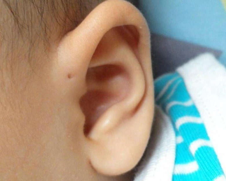 Gros plan sur un sinus préauriculaire, un petit trou discret devant l'oreille