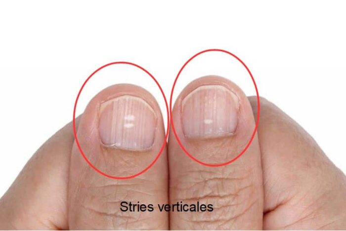 Santé et bien-être : ces stries sur vos ongles qui en disent long