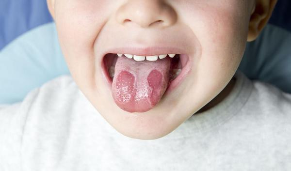 Langue blanche au réveil : ce que votre corps essaie de vous dire