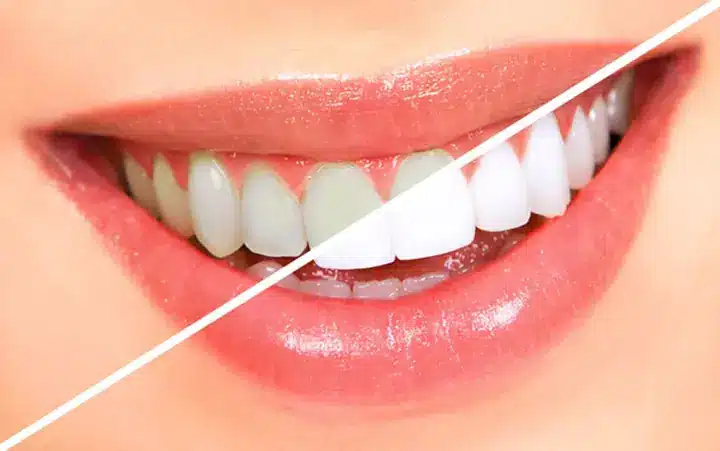 Le riz, nouvel allié de votre sourire : une méthode minute pour des dents éclatantes