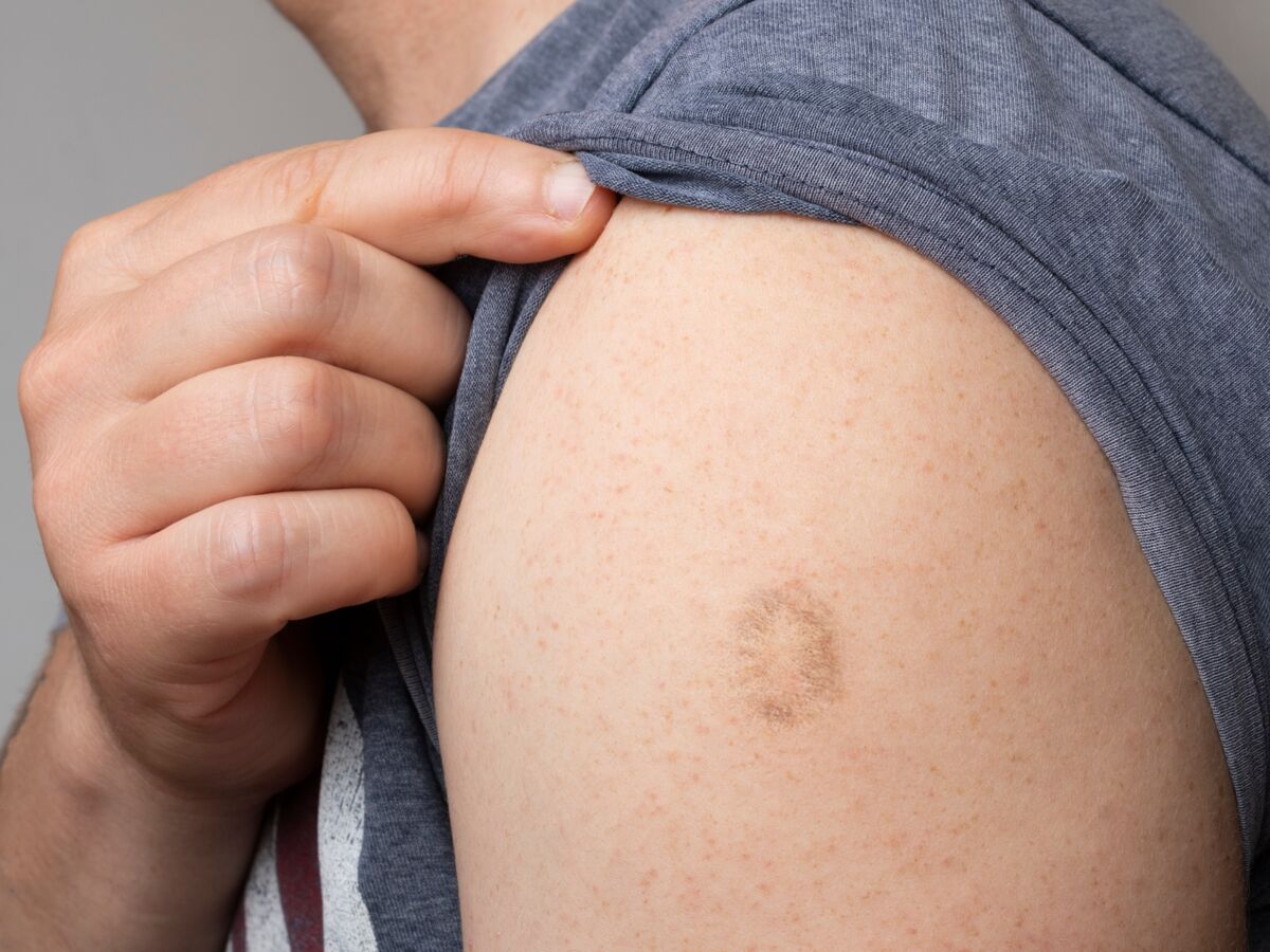Cicatrice de vaccin contre la variole