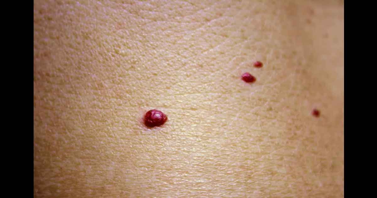 Angiomes cerises sur la peau