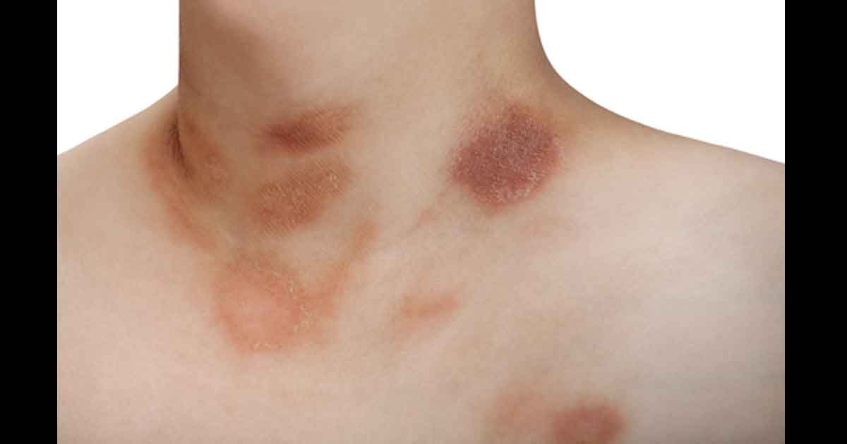 Pityriasis rosé sur la peau