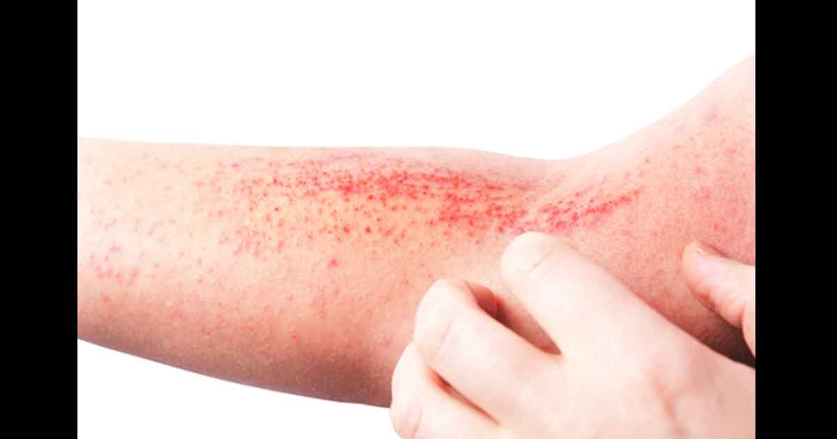 Dermatite de contact sur la peau