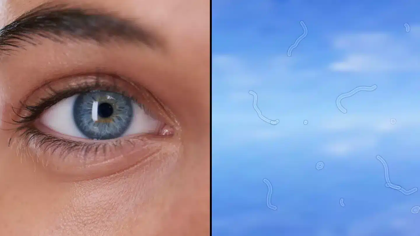 Illustration de corps flottants oculaires