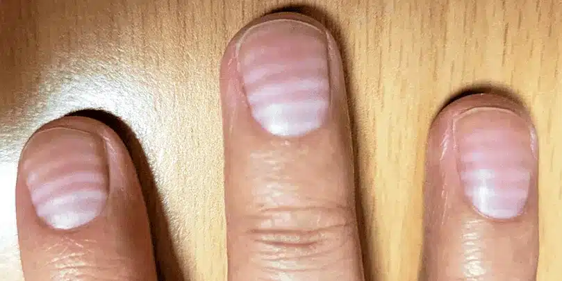 Santé et bien-être : ces stries sur vos ongles qui en disent long