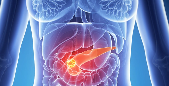Cancer du pancréas en pleine expansion : ce que la science découvre sur ses origines mystérieuses