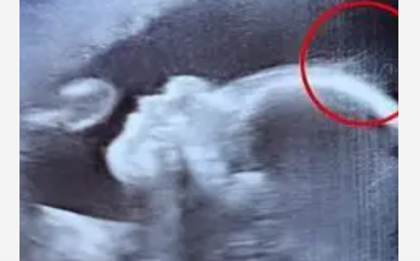 Échographie montrant des détails du fœtus