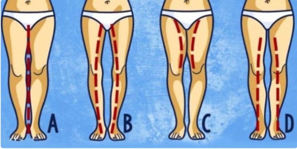 Illustration schématique des différentes morphologies du bassin féminin