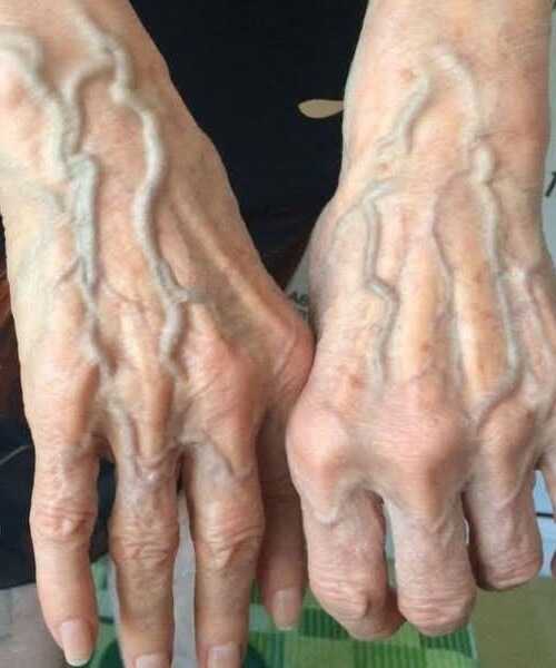 Illustration de veines visibles sur un bras