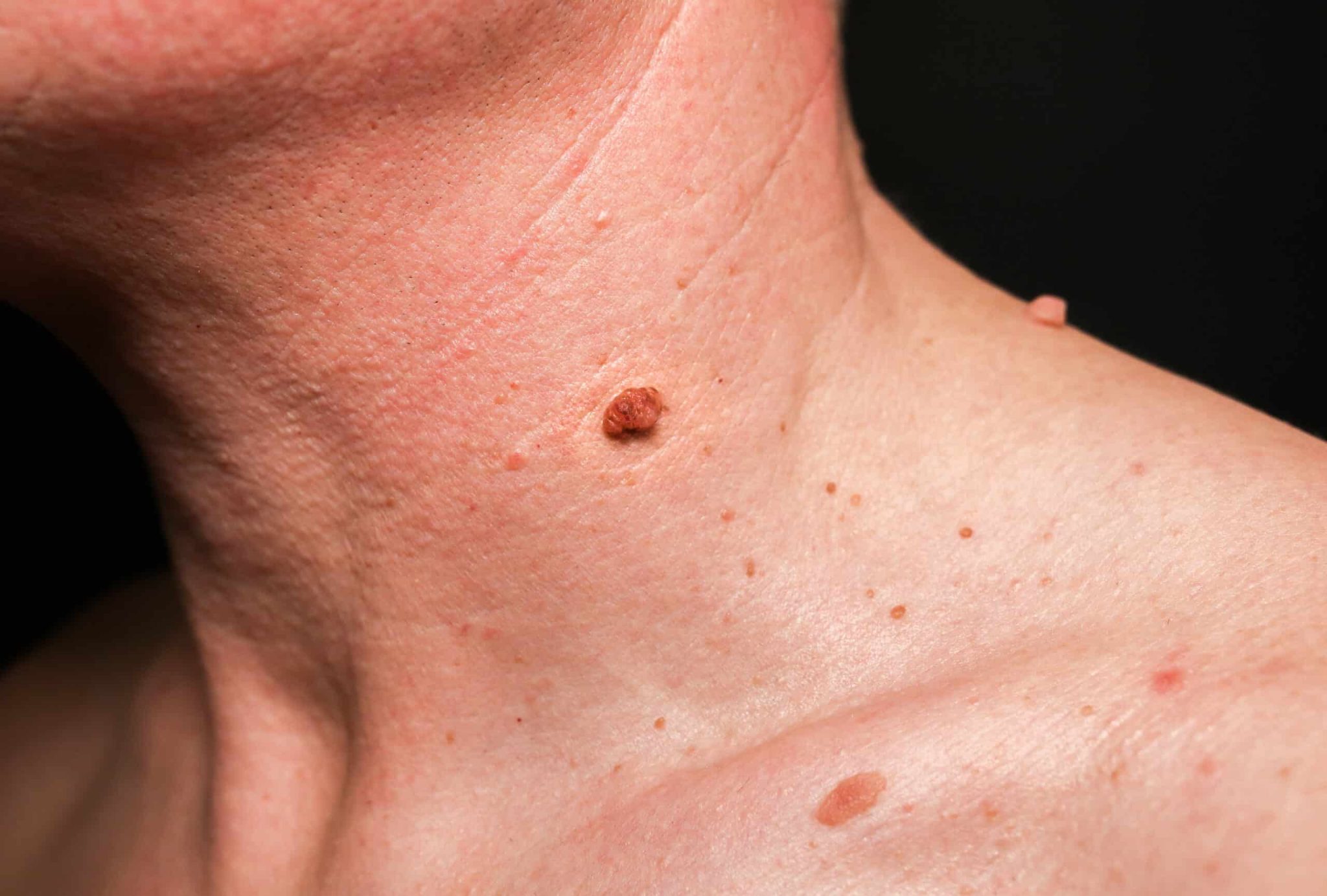 Zoom sur une épiderme avec de petites imperfections cutanées