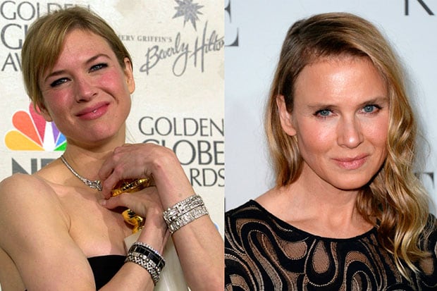 Quand la chirurgie esthétique tourne à l’obsession : ces visages célèbres qui inquiètent