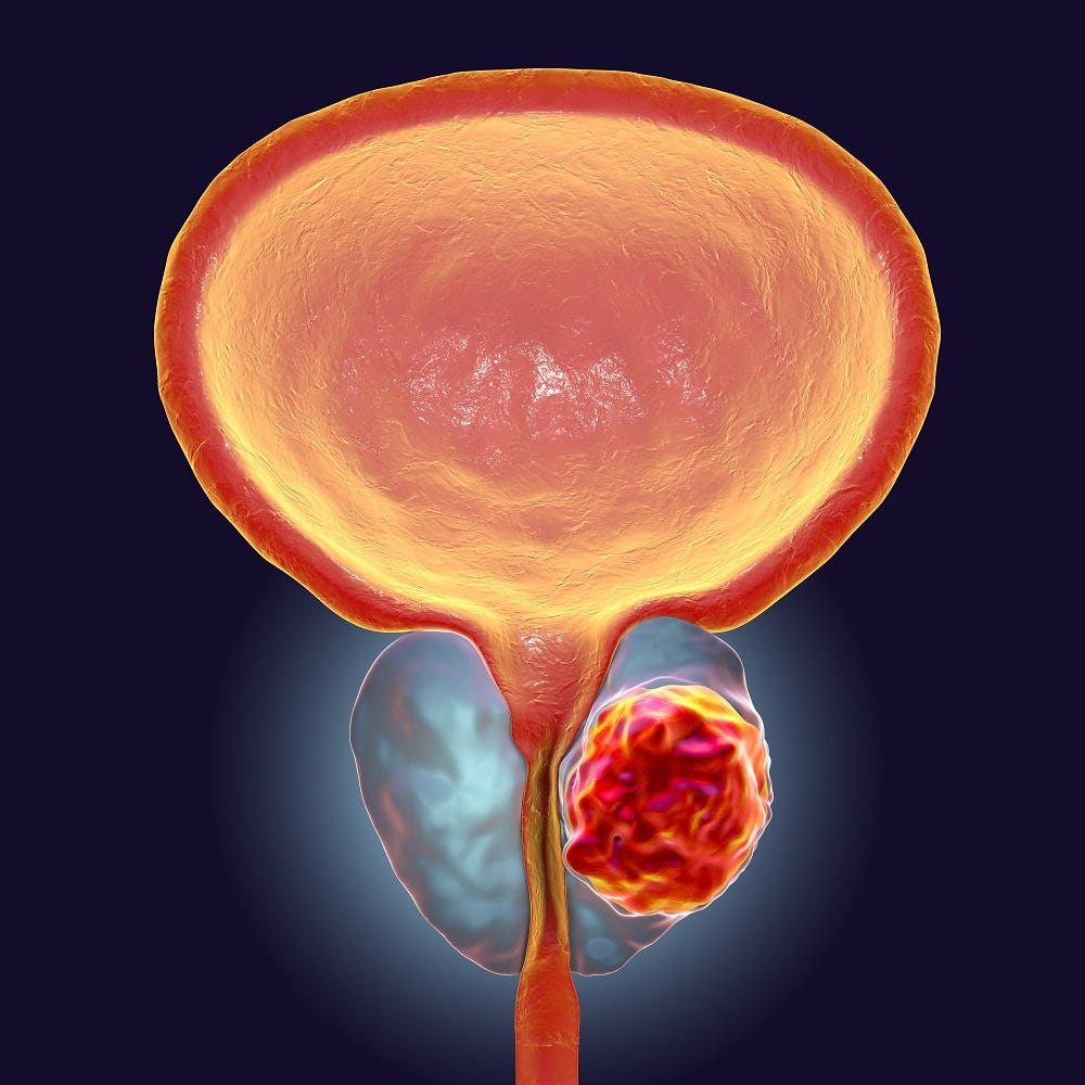 Cancer de la prostate : cette habitude anodine pourrait multiplier par près de 1,5 le risque mortel
