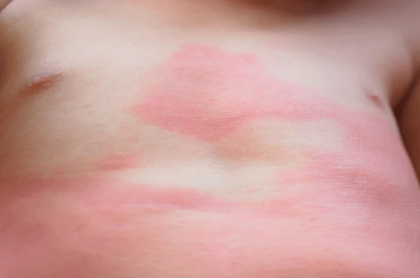Ces petits points rouges sur votre peau : quand faut-il vraiment s’inquiéter ?