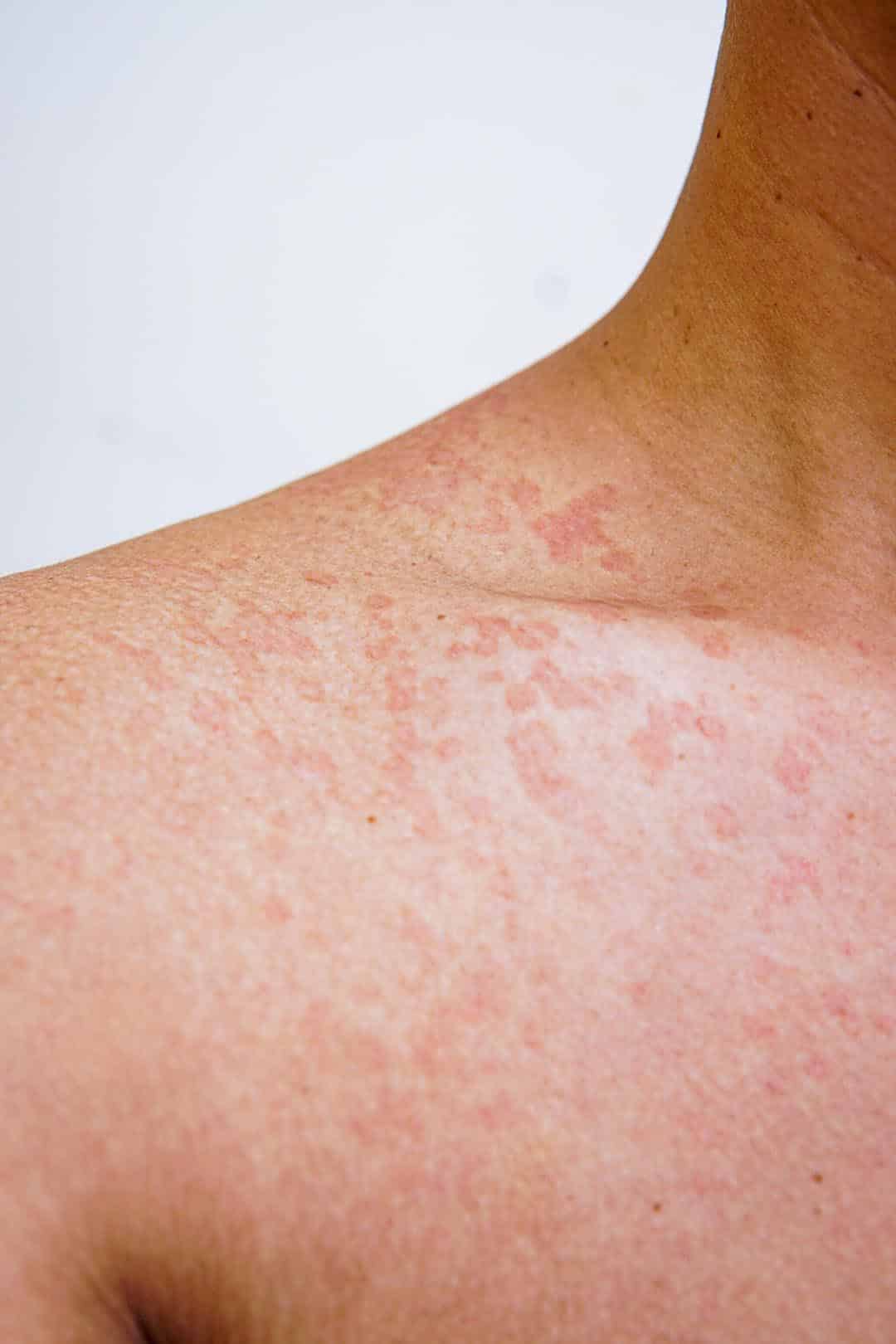 Peau qui vous parle : ces 7 signes cutanés à prendre très au sérieux