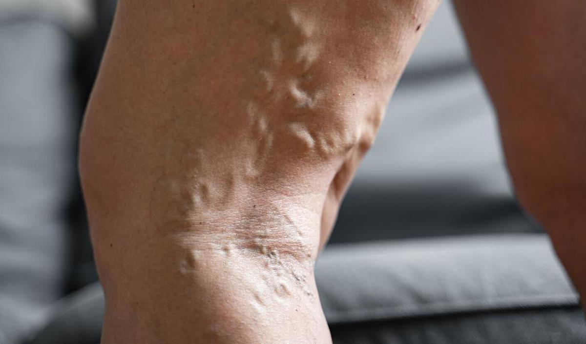Illustration de varices sur une jambe