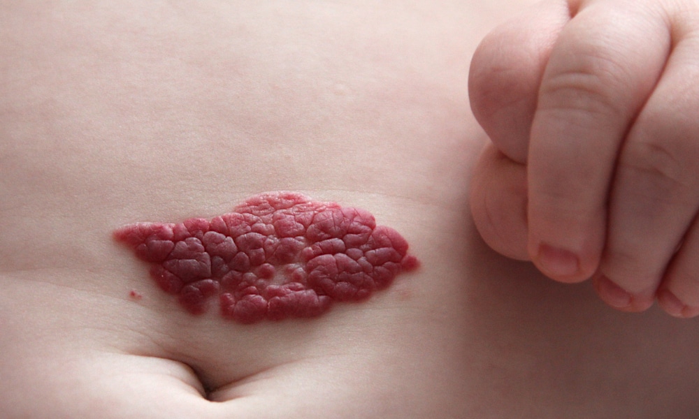 Ces petits points rouges sur votre peau : quand faut-il vraiment s’inquiéter ?