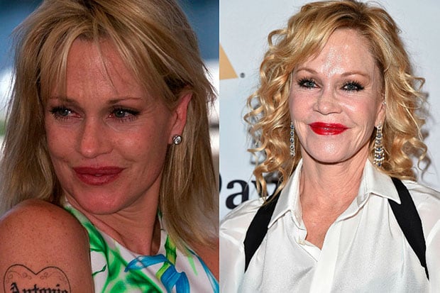 Quand la beauté tourne à l’excès : ces visages célèbres que la chirurgie a transformés