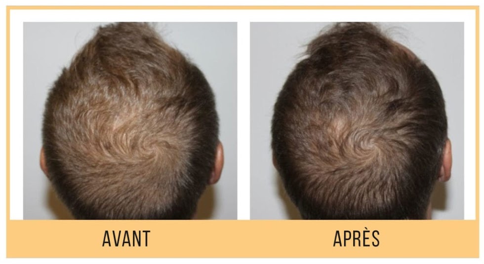 Comparaison avant/après soin du cuir chevelu
