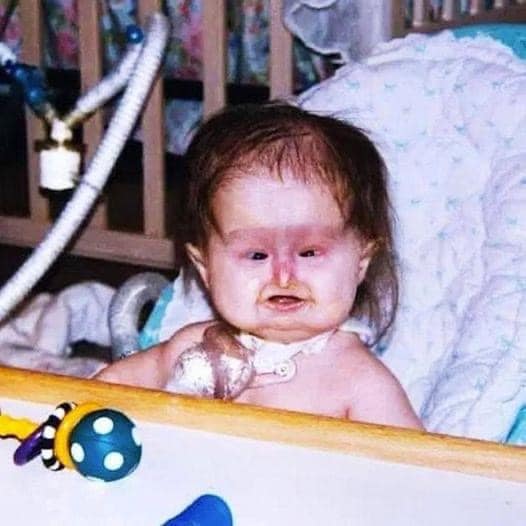 Née avec un syndrome qui ne touche que 250 personnes dans le monde, elle est aujourd'hui un modèle de force et d'espoir