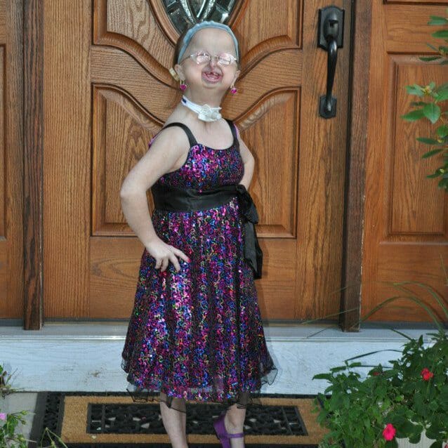 Née avec un syndrome qui ne touche que 250 personnes dans le monde, elle est aujourd'hui un modèle de force et d'espoir