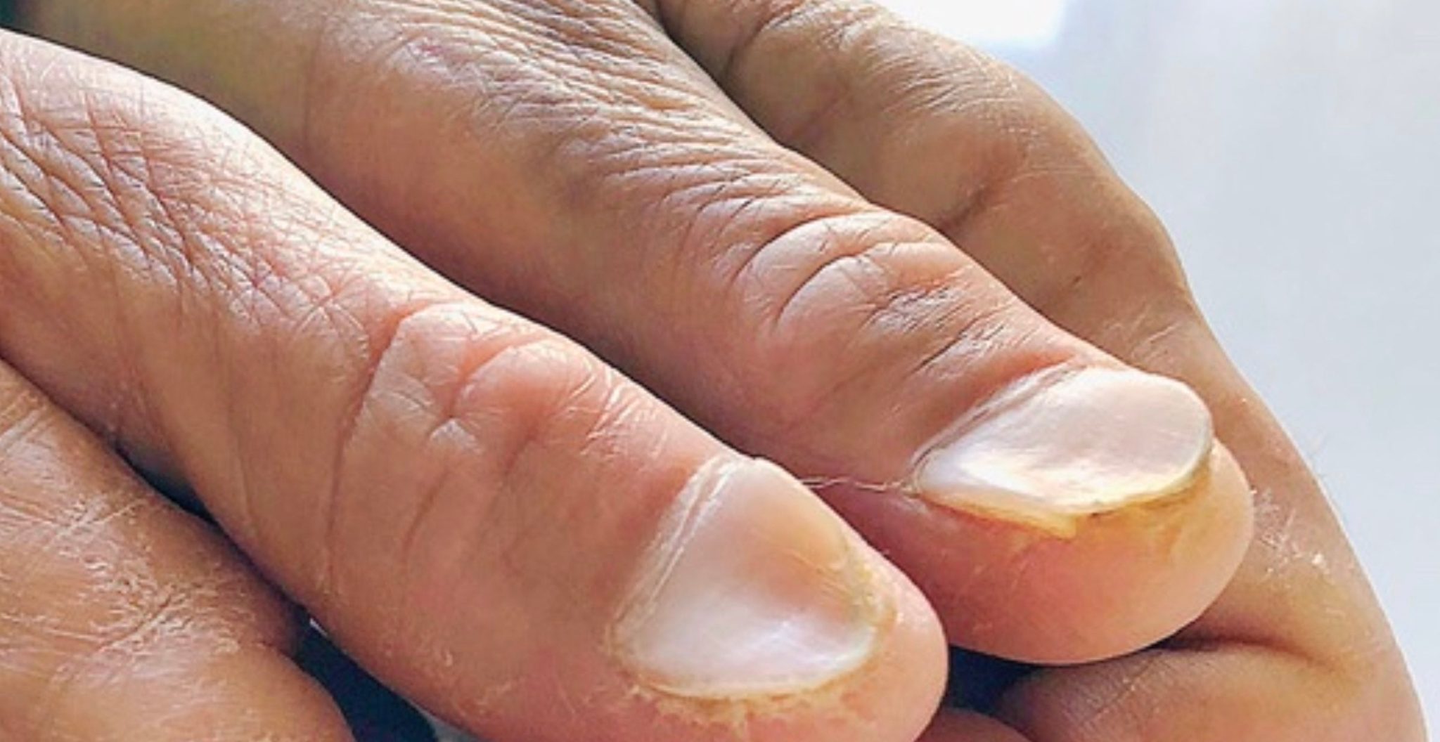 Ongles concaves en forme de cuillère