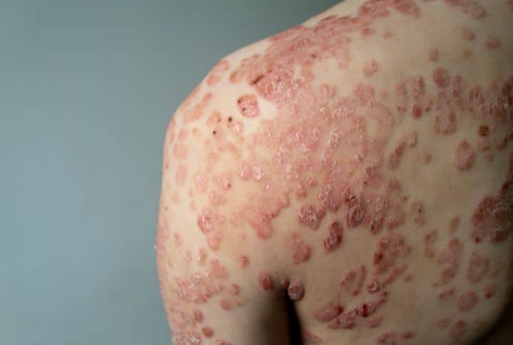 Peau qui parle : ces 7 signes cutanés que vous ne devriez jamais prendre à la légère