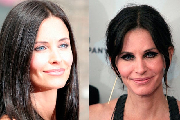 Quand la beauté tourne à l’excès : ces visages célèbres que la chirurgie a transformés