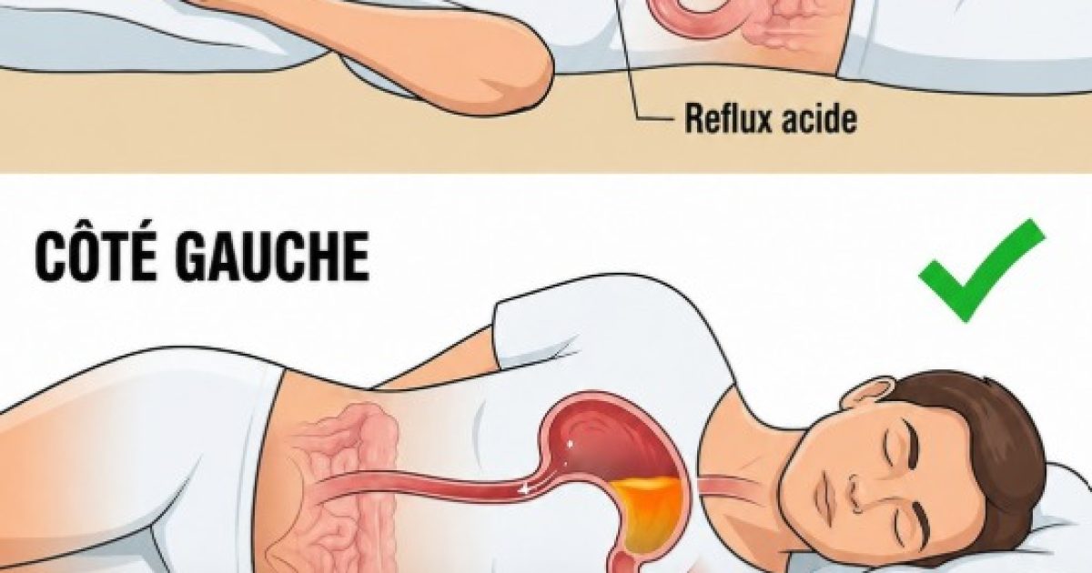 Reflux nocturnes : pourquoi dormir sur le côté gauche change vraiment tout