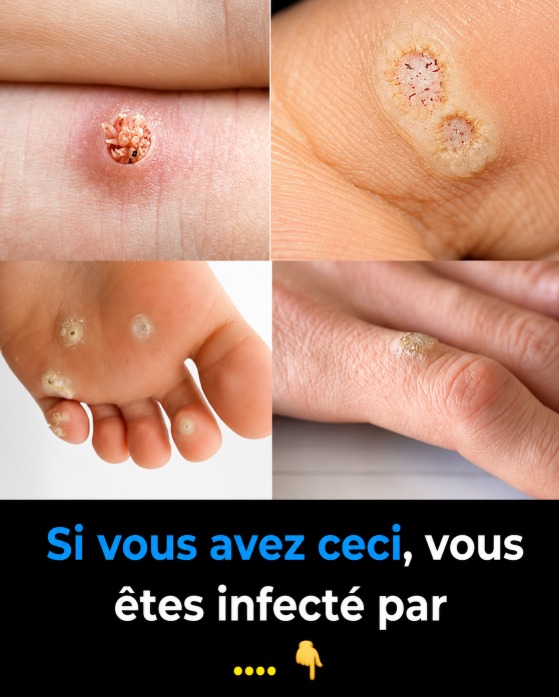 Verrues : tout comprendre sur leurs types et les remèdes maison qui fonctionnent vraiment