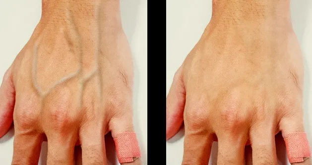 Personne marchant dans la nature, symbolisant l'activité physique bénéfique