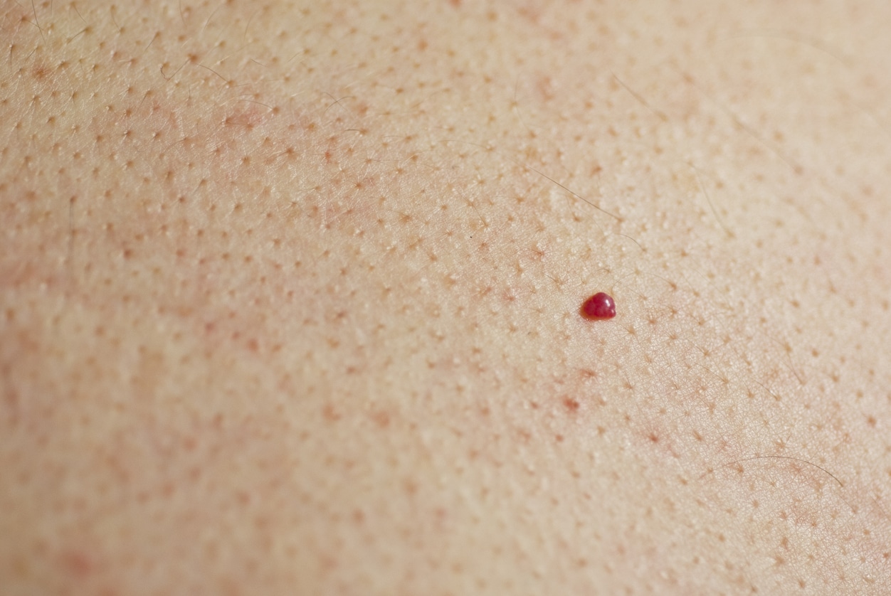Ces petits points rouges sur votre peau : quand faut-il vraiment s’inquiéter ?