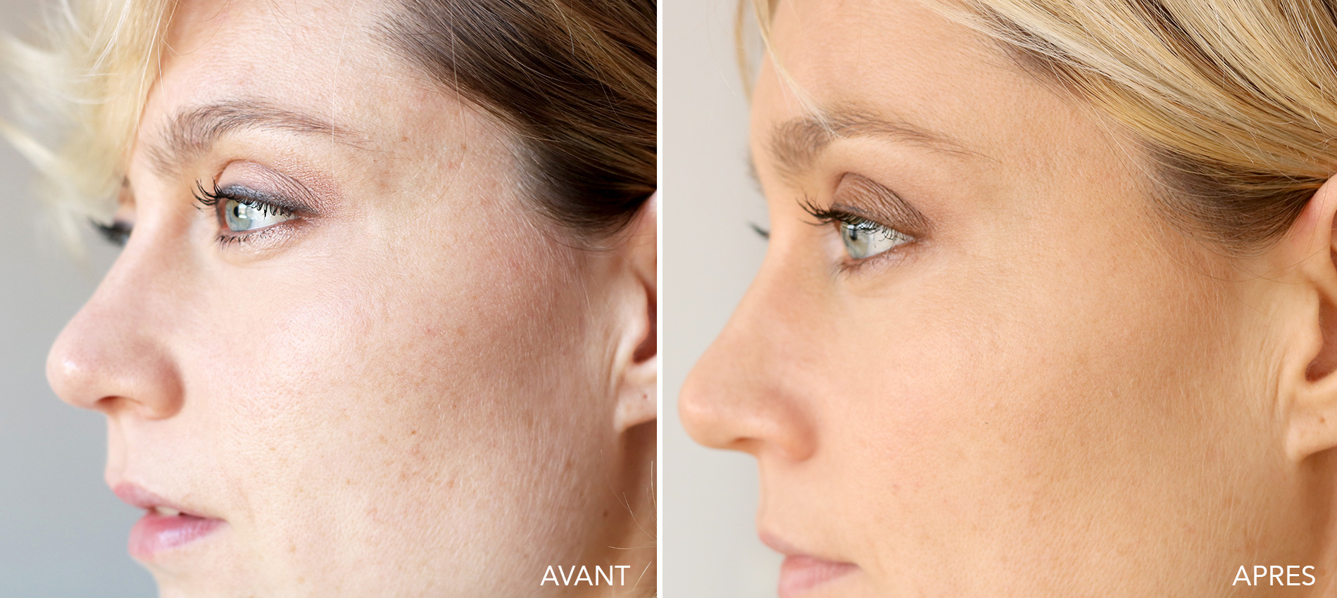 Comparaison avant/après traitement de taches brunes sur la peau