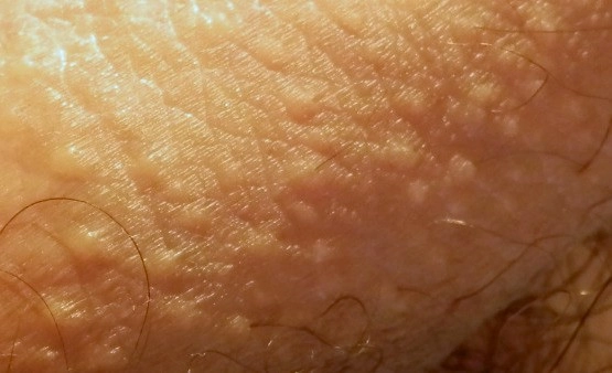 Petits points blancs sur la peau : que sont vraiment les grains de Fordyce ?