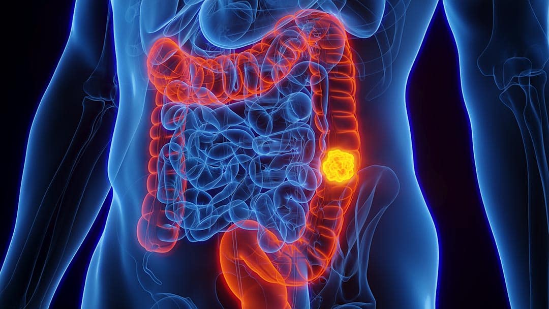 À 20 ans, elle ignorait que ces symptômes digestifs courants cachaient un cancer colorectal incurable
