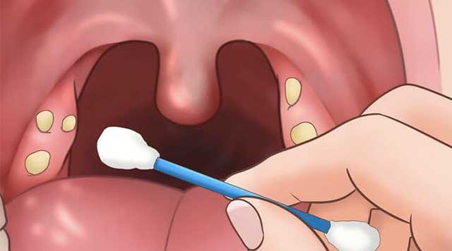 Ces petites boules blanches qui se cachent dans la gorge : un secret bien gardé de la mauvaise haleine