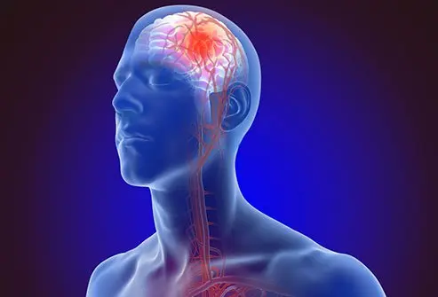 Stroke Symptoms and Treatment, Warning Signs