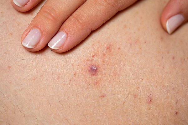 Ingrown hairs - NHS