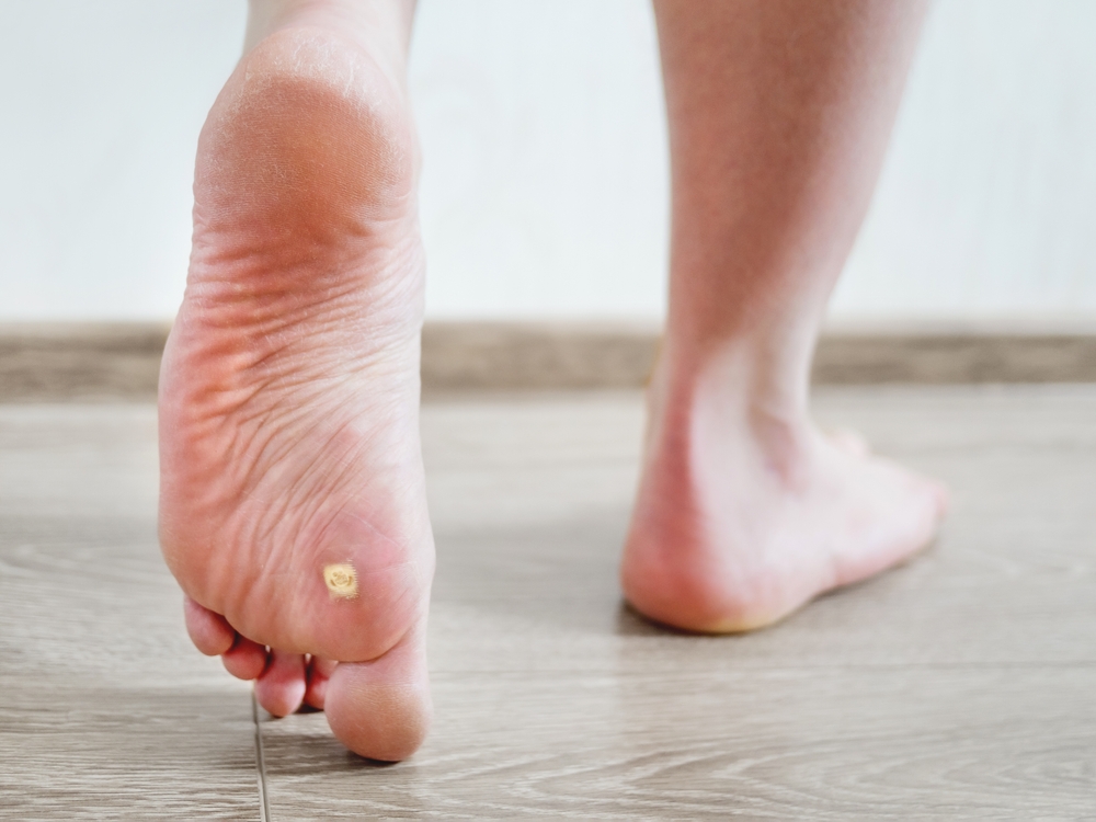 Close up photo of plantar wart on man