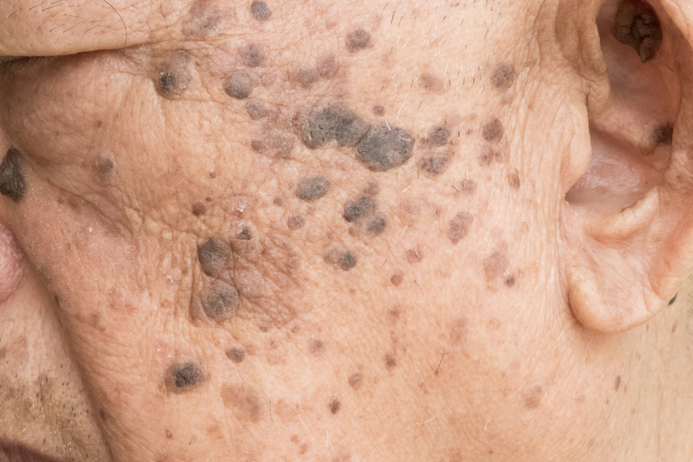 Closeup of age spots skin (liver spots) in 90 years old man.