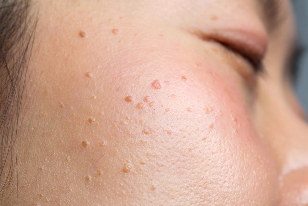 Closeup in seborrheic keratosis, pore, acne and wrinkles in face woman uneven skin.