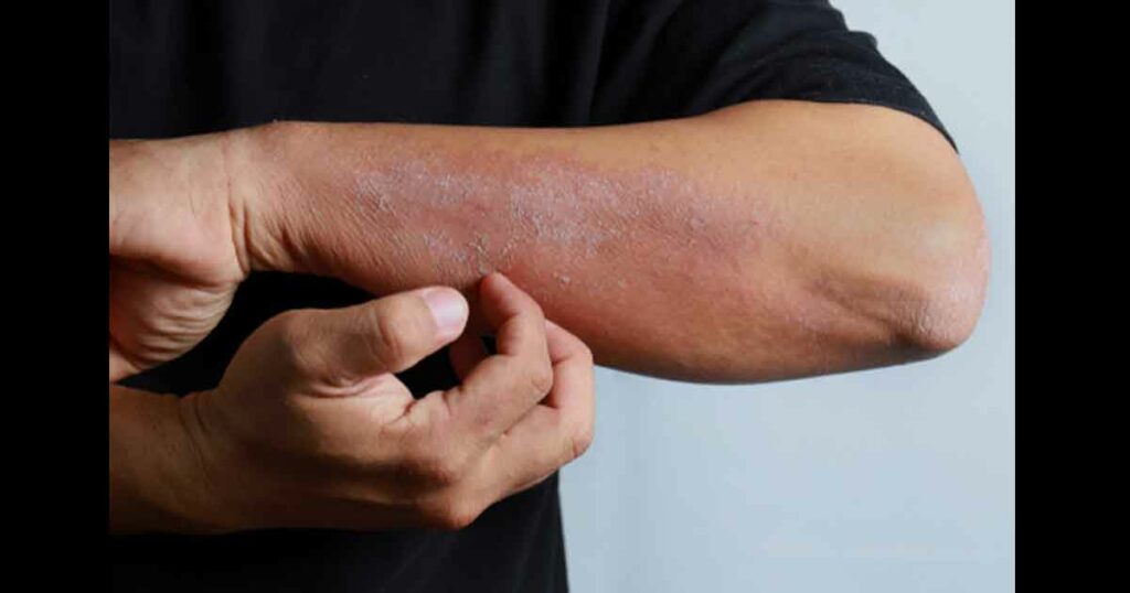 Close up dermatitis on man hand, allergic rash dermatitis eczema skin of a patient.