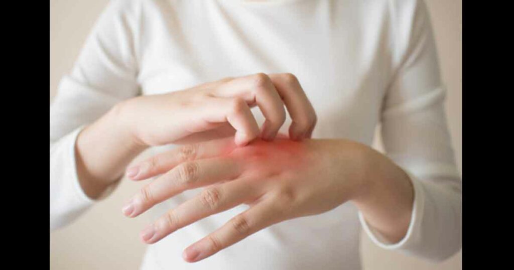 Young woman scratching the itch on her hands w/ redness rash.