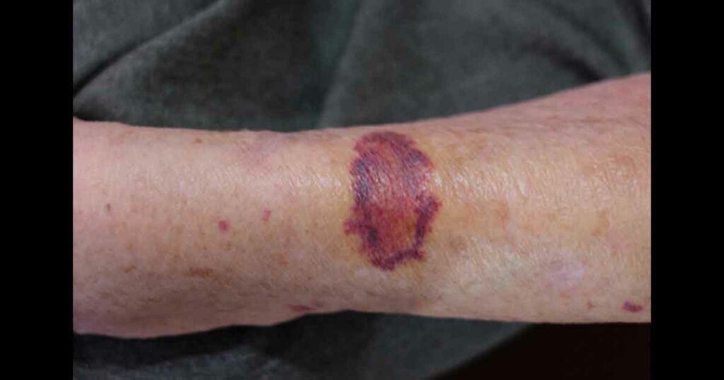 Senile purpura on an arm of an Asian elderly woman.