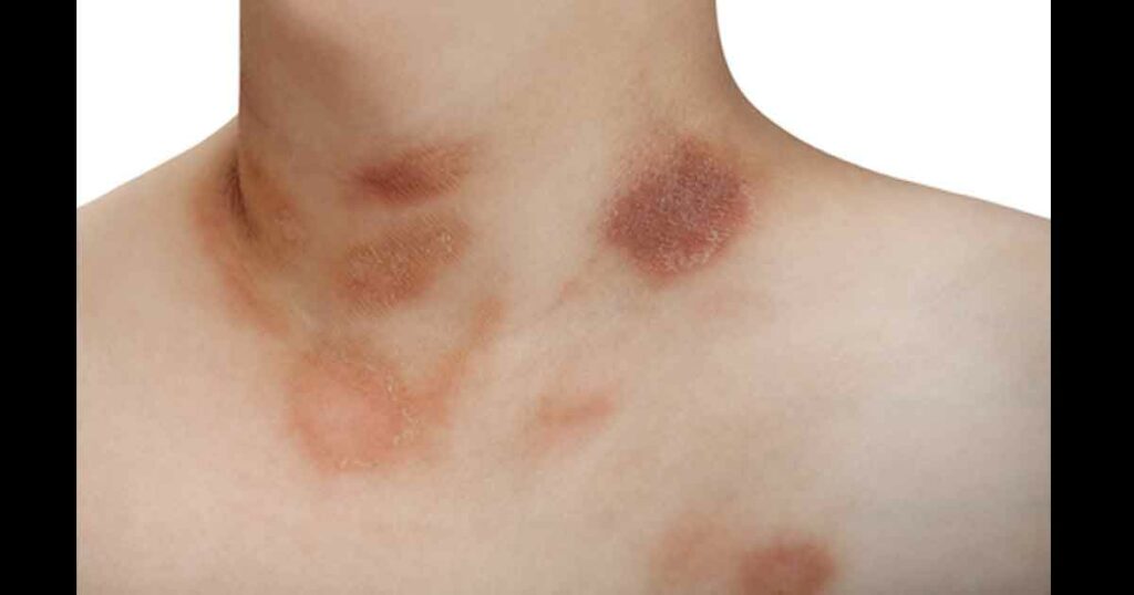 One person with Pityriasis rosea disease on the chest and neck