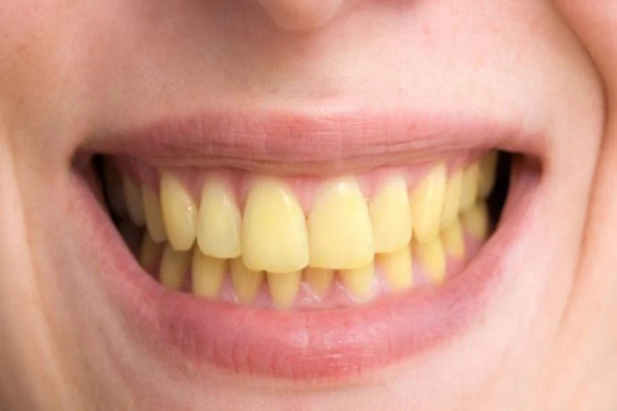 Comparaison avant/après traitement naturel pour dents blanches