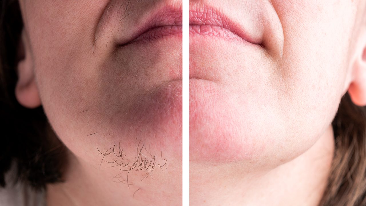 Femme se faisant épiler le menton au laser