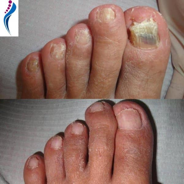 Fini les ongles de pieds trop épais : le rituel maison qui change tout