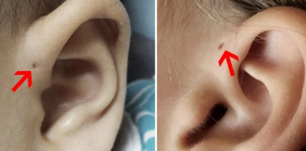 Illustration schématique montrant l'emplacement du sinus préauriculaire sur le visage