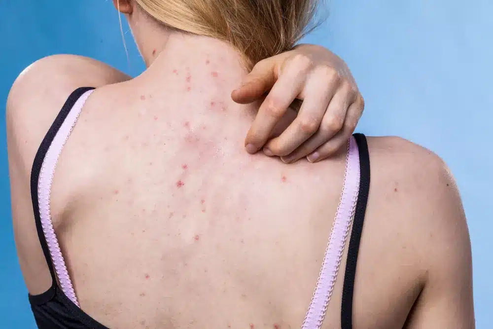 Ces petits points rouges sur votre peau : quand faut-il vraiment s’inquiéter ?